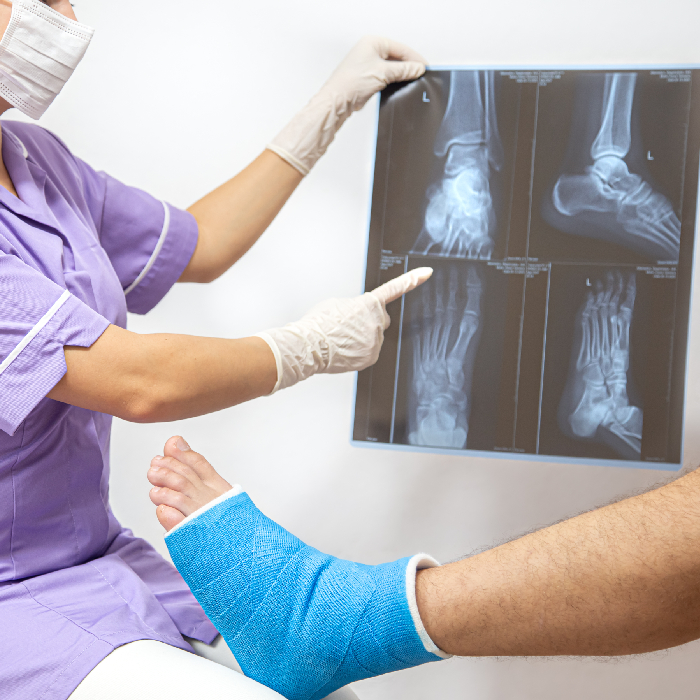 Fracture & Complex Trauma Surgery in Pune
